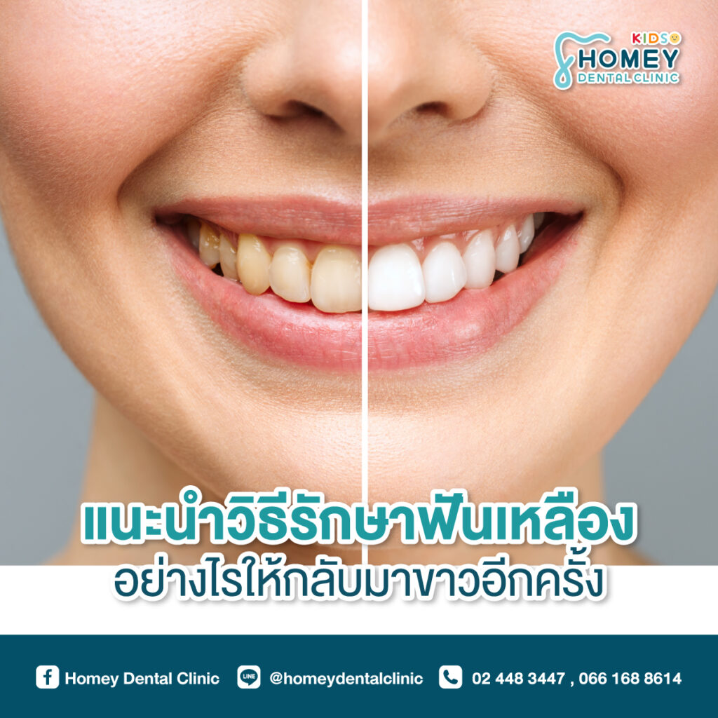 แนะนำวิธีรักษาฟันเหลืองอย่างไรให้กลับมาขาวอีกครั้ง