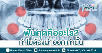 ฟันคุดคืออะไร? ทำไมต้องผ่าออกเท่านั้น